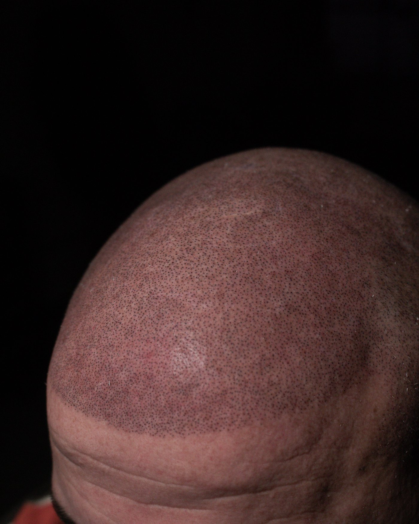 Healed scalp micropigmentation result at NARA, published with permission.