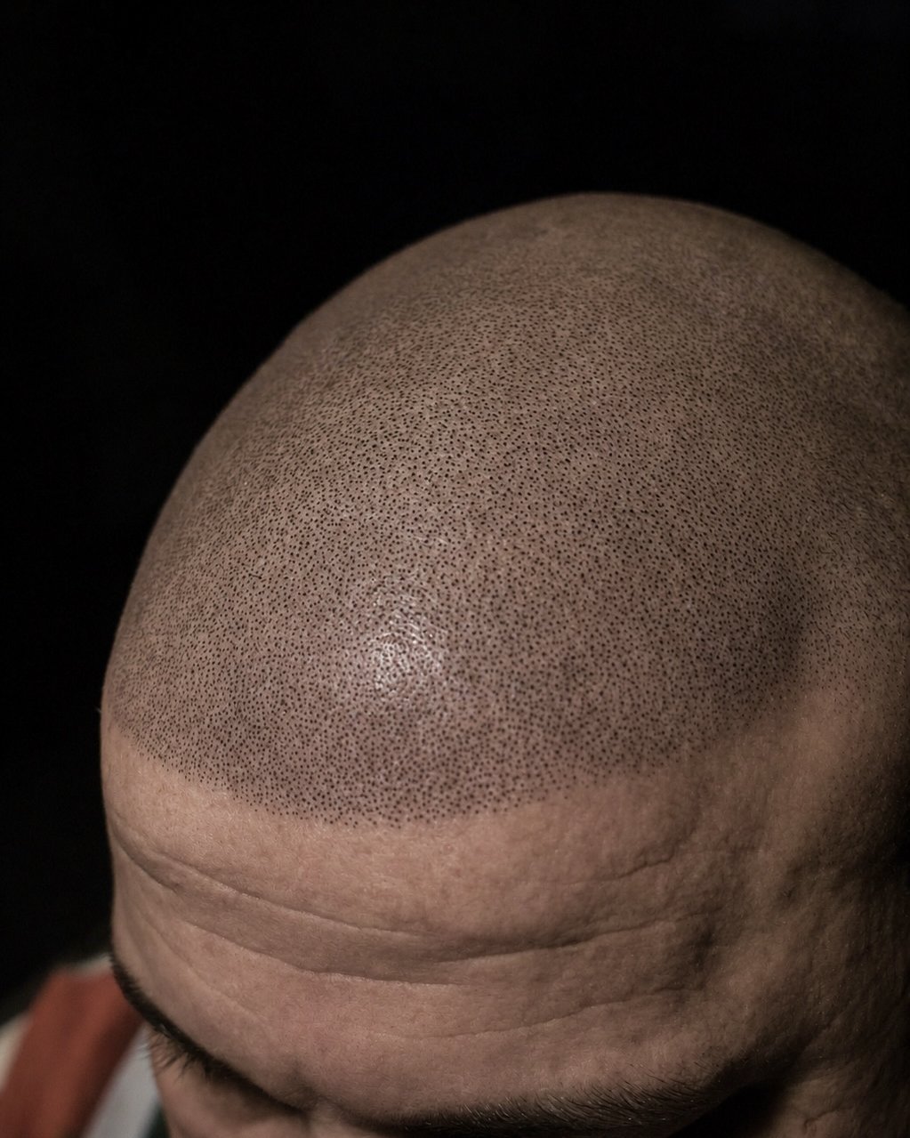 Micropigmentación capilar en NARA: detalle del punteado sobre la coronilla y la línea frontal.